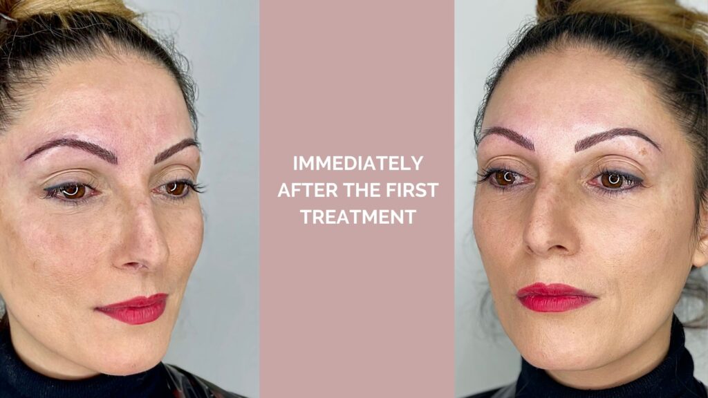 (microblading) immediately after the first treatment 